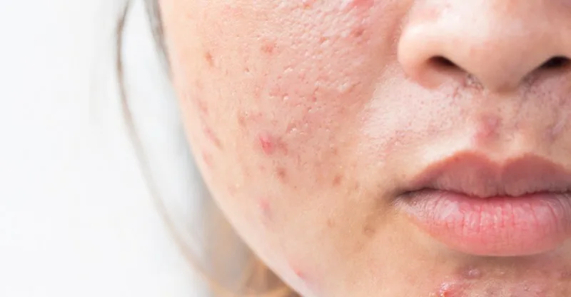 Dưỡng ẩm cho da mụn: Không còn là lựa chọn, mà là điều kiện bắt buộc