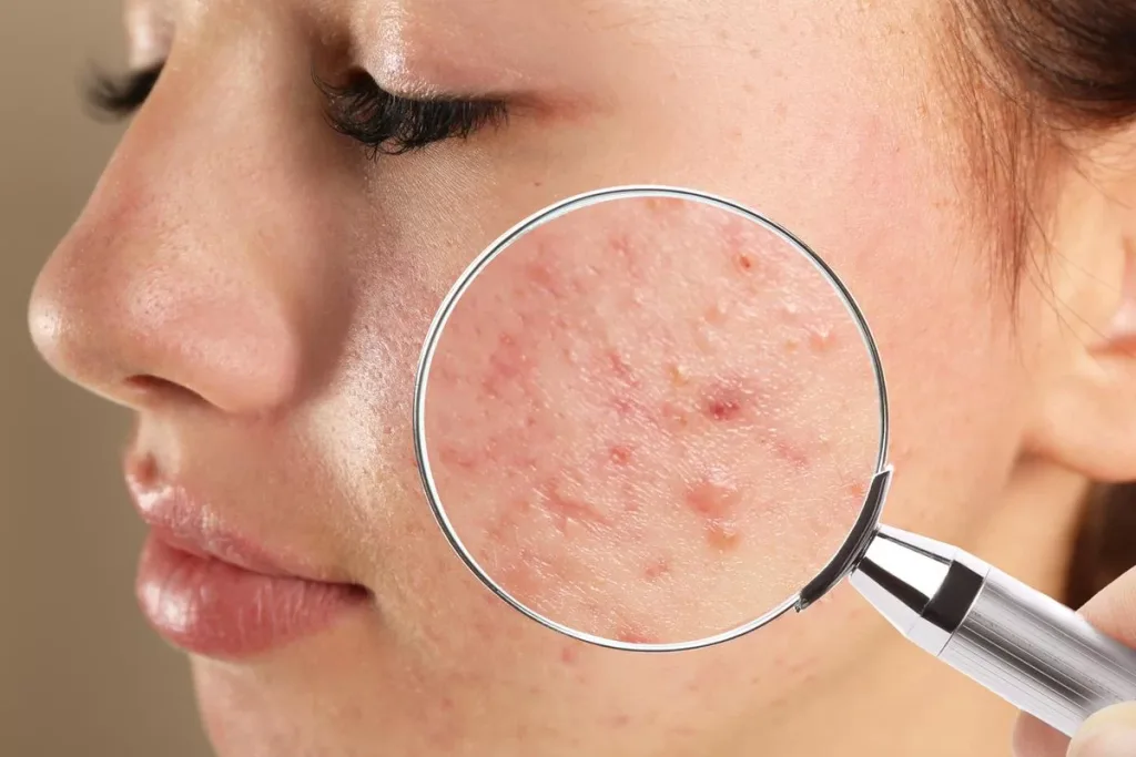 Bộ sản phẩm chăm sóc da mụn của Mineaderm – Giải pháp cho da dầu nhạy cảm