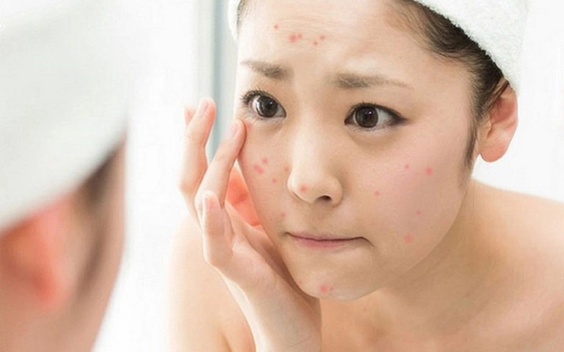 Da dầu mụn: Nguyên nhân, cách chăm sóc và sản phẩm phục hồi hiệu quả